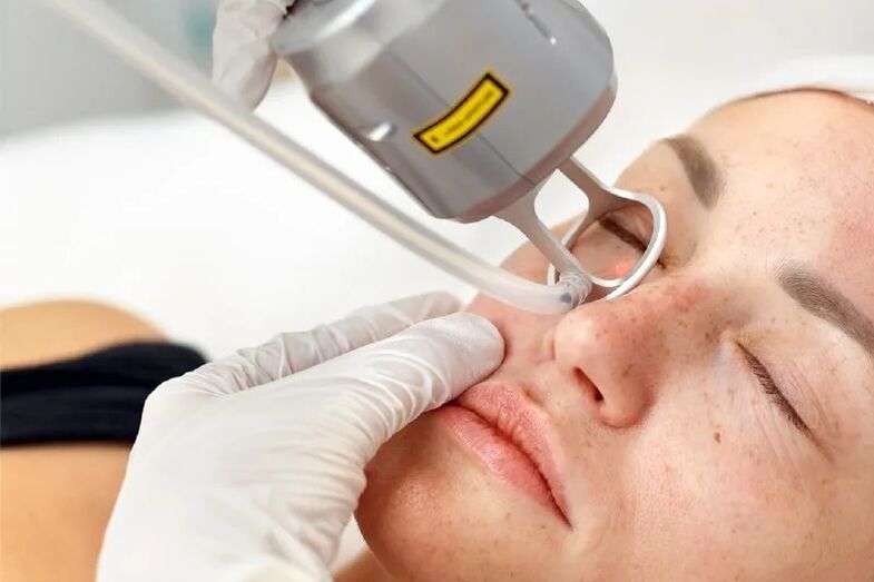 plataforma láser para a corrección da pel facial